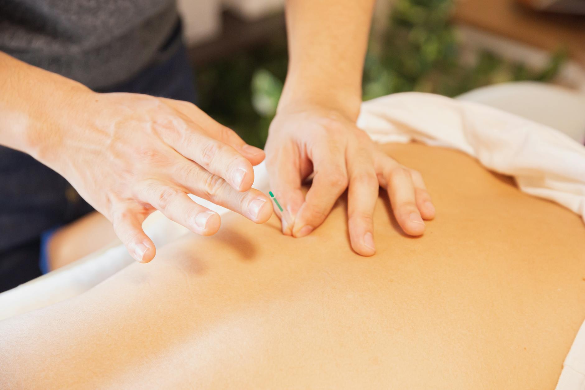 Acupuncture needles placed along patient back with practitioner hands visible